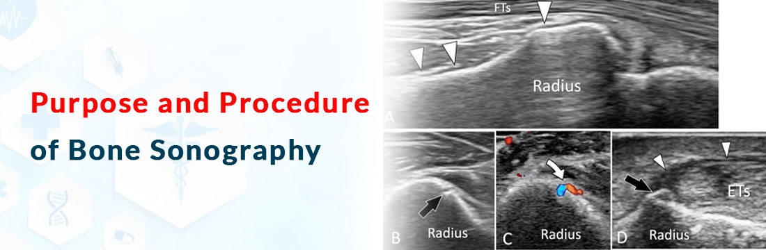  Purpose and Procedure of Bone Sonography